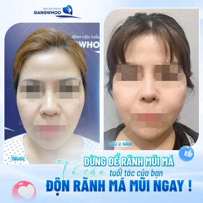 Độn Rãnh Mũi Má Xóa Mờ Vết Tích Thời Gian Trên Khuôn Mặt 6 Độn rãnh mũi má gương mặt và diện mạo trẻ đẹp không còn dấu hiệu tuổi tác