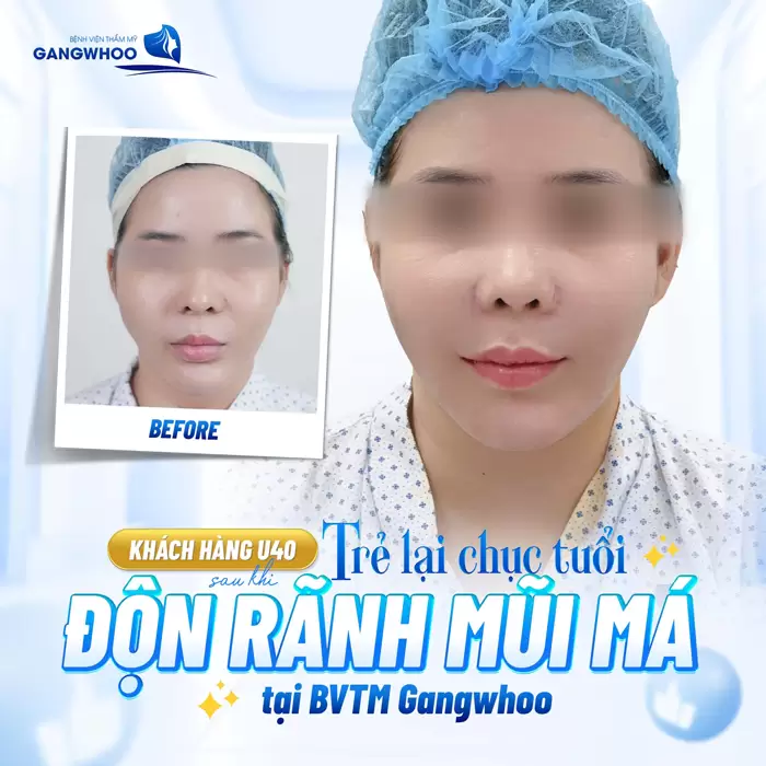 Độn Rãnh Mũi Má Xóa Mờ Vết Tích Thời Gian Trên Khuôn Mặt 1 Độn rãnh mũi má khách U40 trẻ lại cả chục tuổi một cách an toàn và hiệu quả