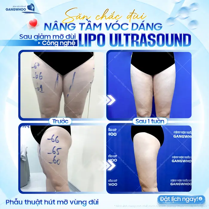 Đùi săn thon gọn nâng tầm vóc dáng sau 1 lần giảm mỡ công nghệ Lipo Ultrasound đã thay đổi hoàn toàn 