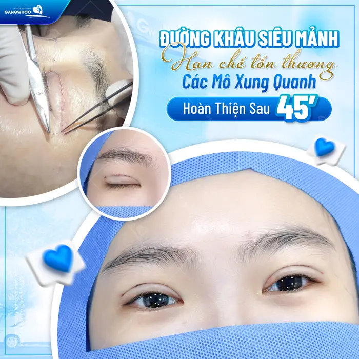 Cắt Mí 4 In 1 Plasma Khắc Phục Mọi Khuyết Điểm, Mắt 2 Mí Đẹp Hoàn Hảo 20 Cắt mí vi phẫuđường khâu siêu mảnh hạn chế tổn thương các mô xung quanh hoàn thiện sau 45 phút
