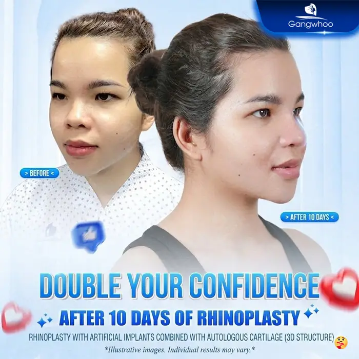 en phau thuat nang mui 7