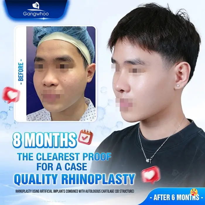 en phau thuat nang mui 8