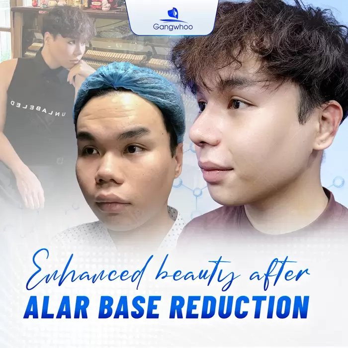 Alar Base Reduction - To Slim Down Your Nose 7 en thu gon canh mui 1