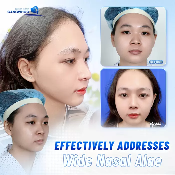 Alar Base Reduction - To Slim Down Your Nose 1 en thu gon canh mui 2