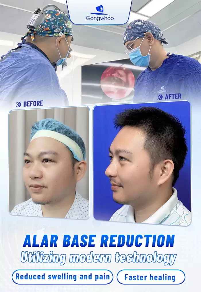 Alar Base Reduction - To Slim Down Your Nose 2 en thu gon canh mui 3