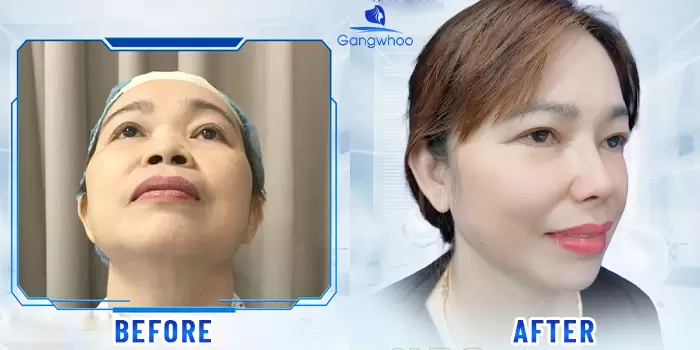 Alar Base Reduction - To Slim Down Your Nose 4 en thu gon canh mui 4