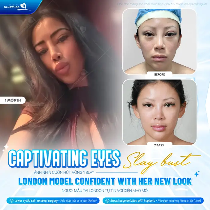Endoscopic eyelid fat removal before and after London model international client