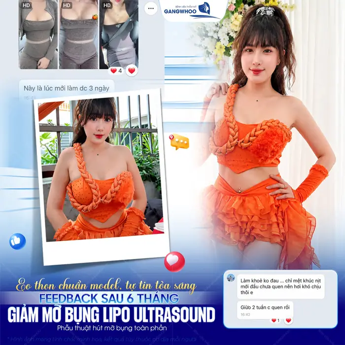 Hút Mỡ Bụng (Lipo Ultrasound) Hiệu Quả, Không Sưng Bầm 49 eo thon chuan model tu tin toa sang sau giam mo bung lipo ultrasound