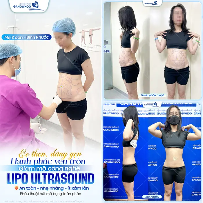 Eo thon, dáng gọn hạnh phúc trọn vẹn với công nghệ giảm mỡ Lipo Ultrasound hiện đại 