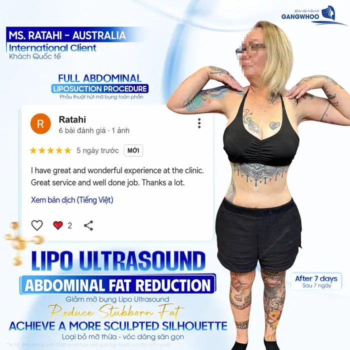 Hút Mỡ Bụng (Lipo Ultrasound) Hiệu Quả, Không Sưng Bầm 39 fb cua khach hang quoc te sau thuc hien hut mo bung tai gangwhoo