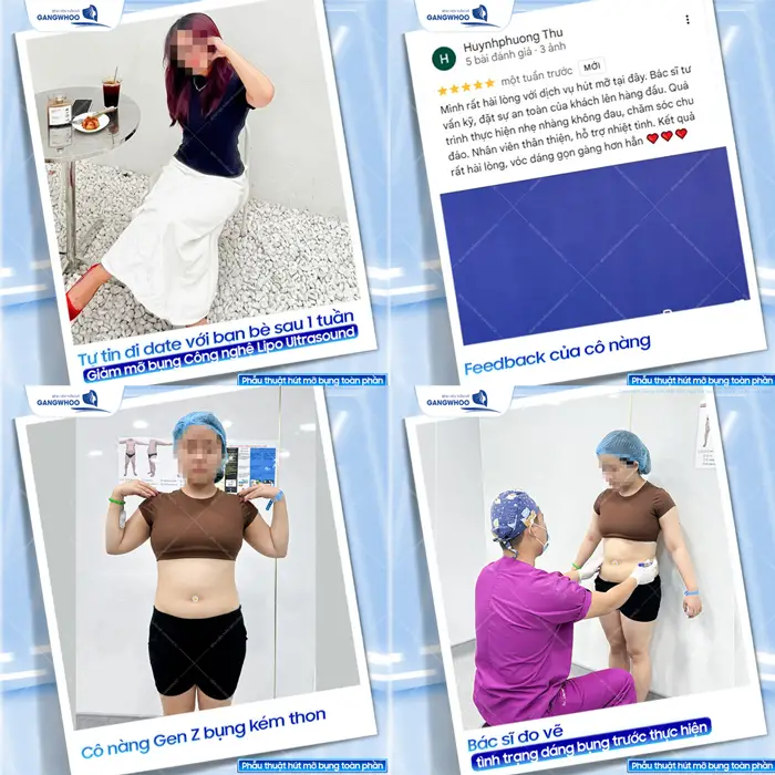 Hút Mỡ Toàn Thân An Toàn, Không Biến Chứng, Hiệu Quả Cao 31 fb cua khach hang sau 1 tuan giam mo bung da tu tin di date voi ban be