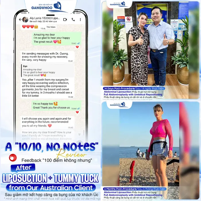 Phẫu Thuật Căng Da Bụng Là Gì? Trường Hợp Nào Nên Và Không Nên Thực Hiện 10 Sau giảm mỡ kết hợp căng da bụng của khách hàng đến từ Úc ngày càng thăng hạng với nhan sắc ngày càng rạng rỡ