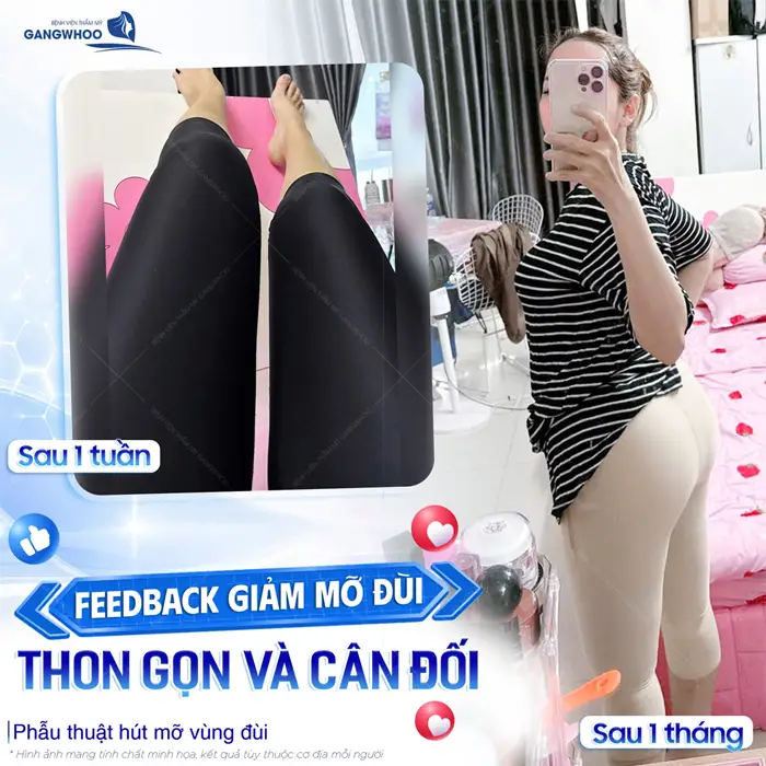 Phẫu Thuật Hút Mỡ Đùi (Lipo Ultrasound) - Bí Quyết Cho Đôi Chân Quyến Rũ 3 Feedback sau giảm mỡ đùi tự tin khoe đôi chân thon gọn và cân đối sau 1 tháng bừng sáng tự tin