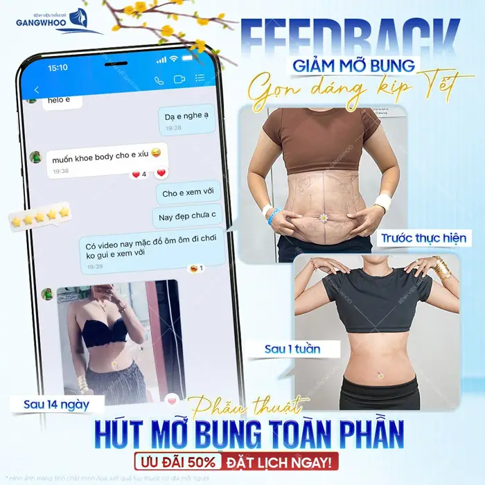 fb phau thuat hut mo bung toan phan tu tin don nam moi