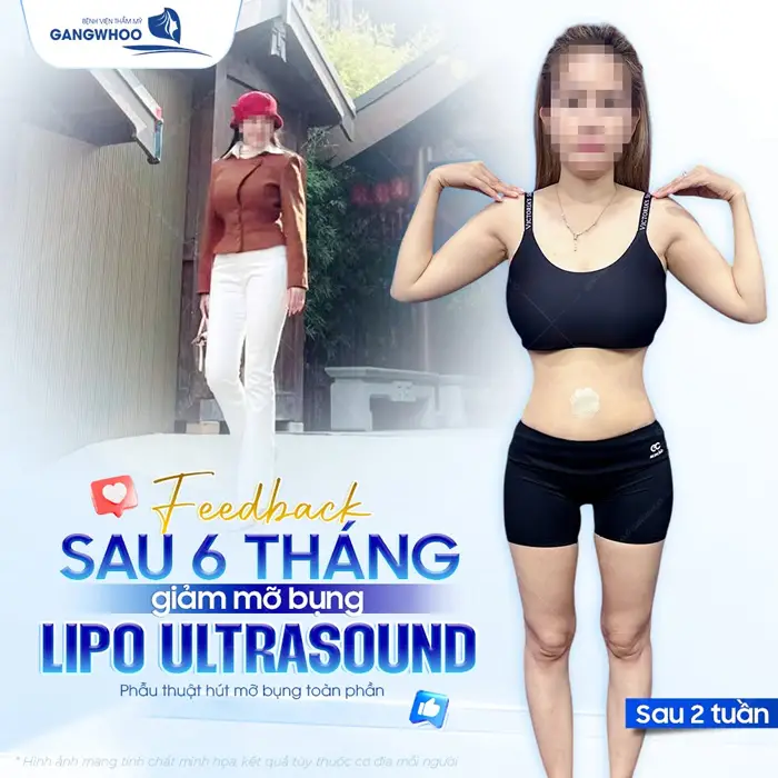 Feedback sau 6 tháng giảm mỡ bụng Lipo Ultrasound sau 2 tuần eo thon gọn hơn thấy rõ