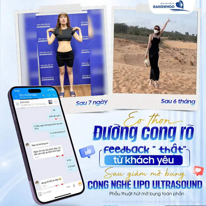 fb that tu khach yeu sau giammo bung cong nghe lipo ultrasound