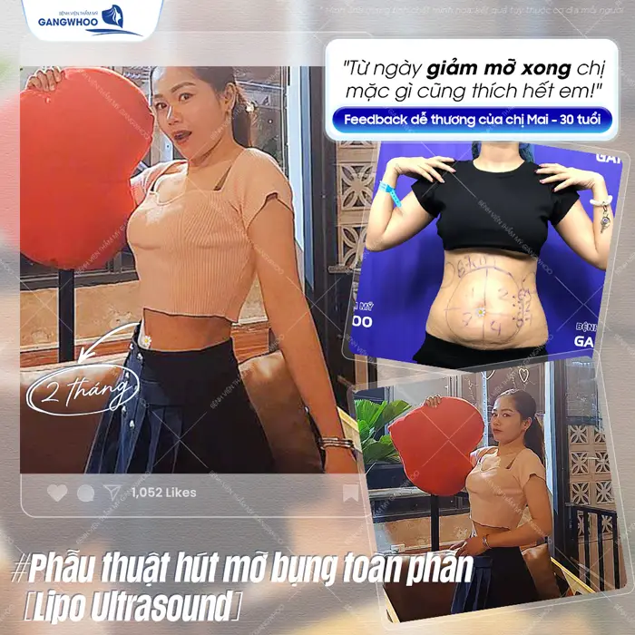 fd kh khoe sau khi giam mo bung 1