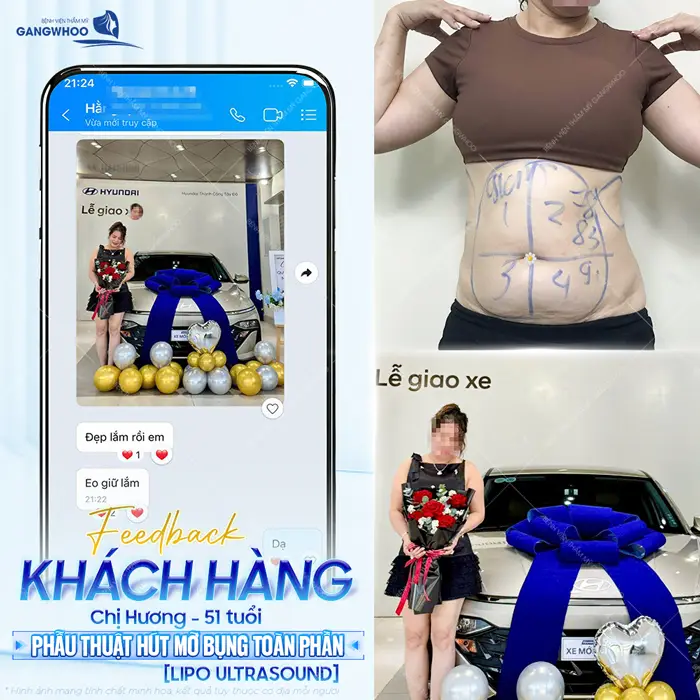 fd kh khoe sau khi giam mo bung 2