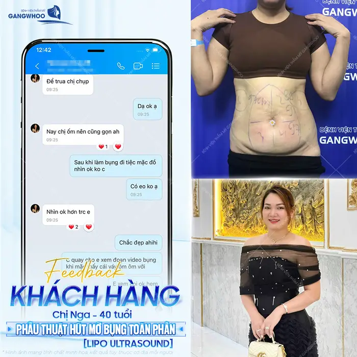 fd kh khoe sau khi giam mo bung 3