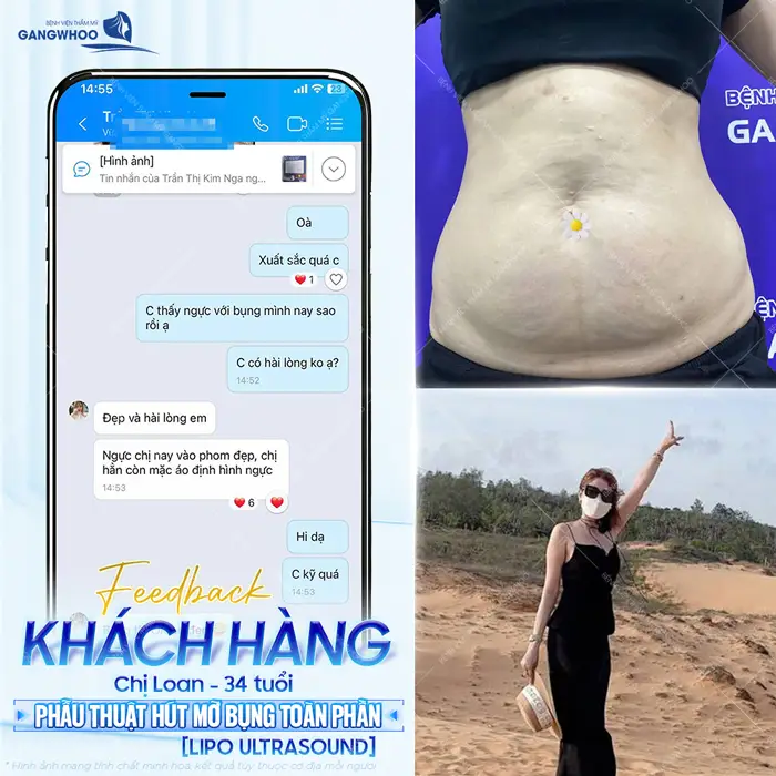 fd kh khoe sau khi giam mo bung 4