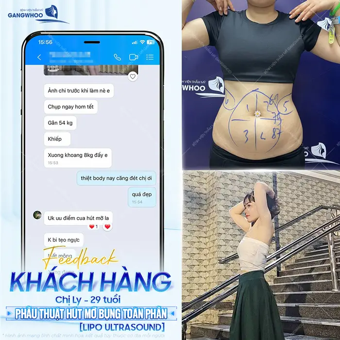 fd kh khoe sau khi giam mo bung 5