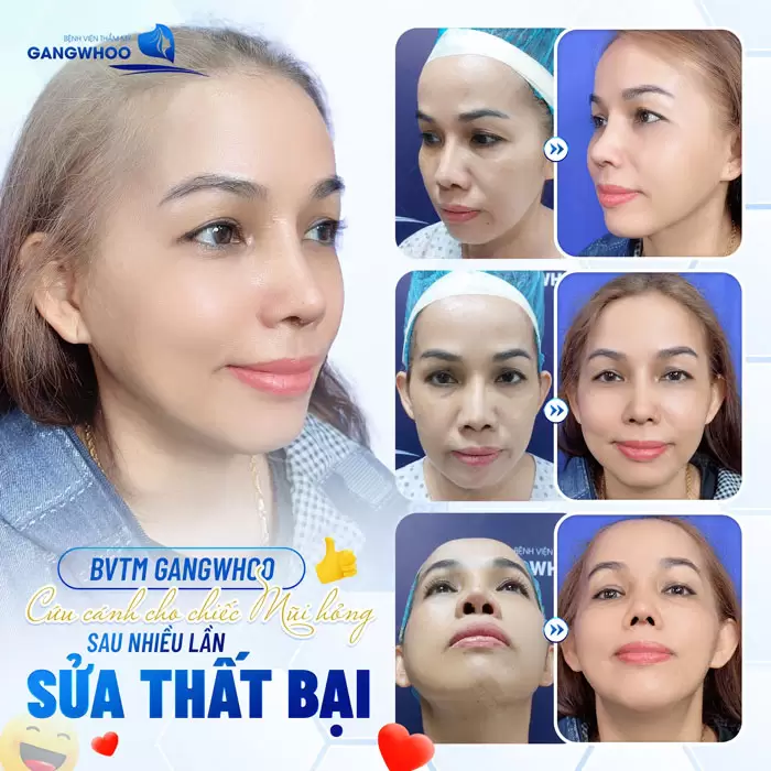 Sửa Mũi Hỏng Phương Pháp Khắc Phục Biến Chứng Sau Nâng Mũi 2 Khắc phục diện mạo đẹp hoàn hảo cho chị khách hàng sau nhiều lần sửa mũi thất bại