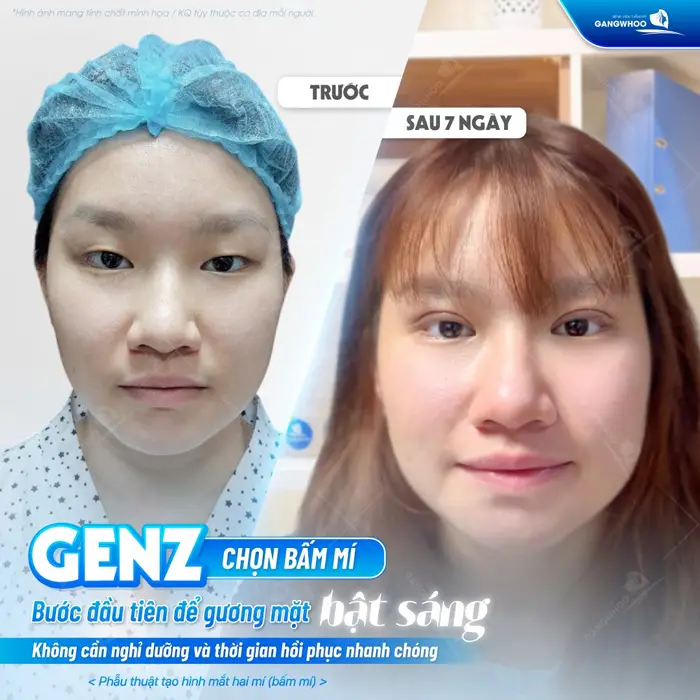 GenZ chọn bấm mí bước ngoặt để gương mặt bừng sáng không cần nghỉ dưỡng và thời gian hồi phục nhanh chóng