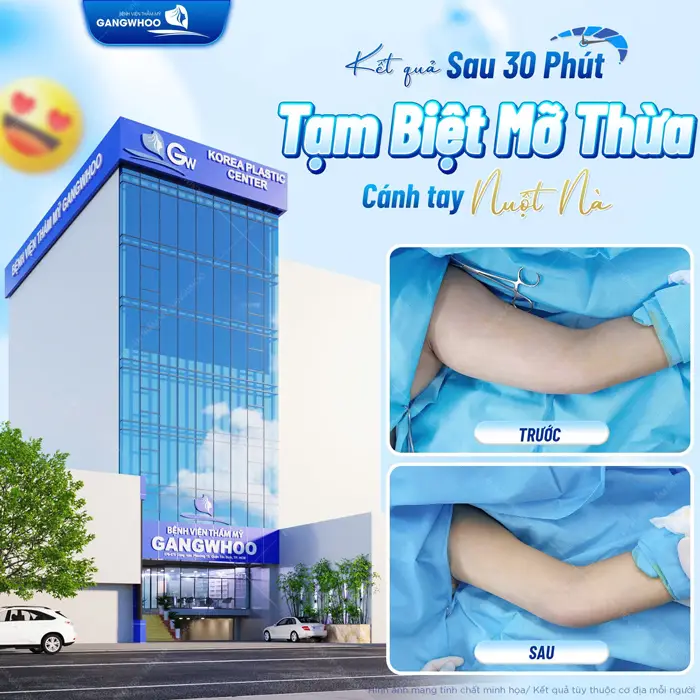 Hút Mỡ Cánh Tay Giúp Lấy Lại Đôi Tay Thon Gọn Nhanh Chóng 4 Tạm biệt mỡ thừa cánh tay nuột nà ngay sau 30 phút thực hiện