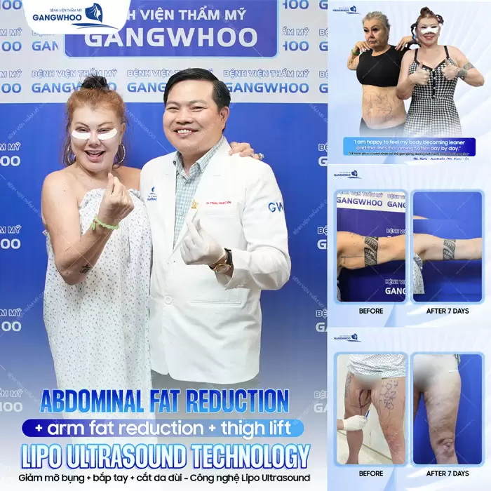Hút Mỡ Cánh Tay Giúp Lấy Lại Đôi Tay Thon Gọn Nhanh Chóng 1 Khách hàng hài lòng về sự cải thiện sau giảm mỡ bụng, hút mỡ bắp tay và cắt da đùi với công nghệ Lipo Ultrasound