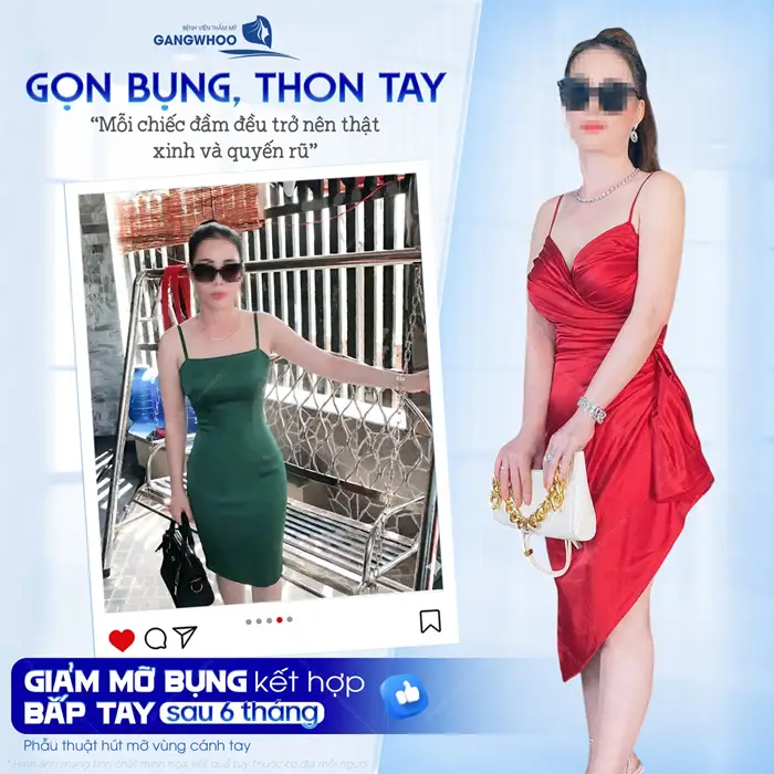 Giảm mỡ bụng kết hợp bắp tay sau 6 tháng tự tin diện body khoe sắc vóc đẹp chuẩn tỷ lệ