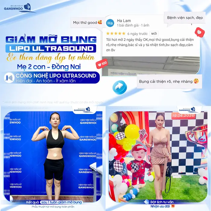 Hút Mỡ Bụng (Lipo Ultrasound) Hiệu Quả, Không Sưng Bầm 38 giam mo bung lipo ultrasound eo thon dang dep tu nhien