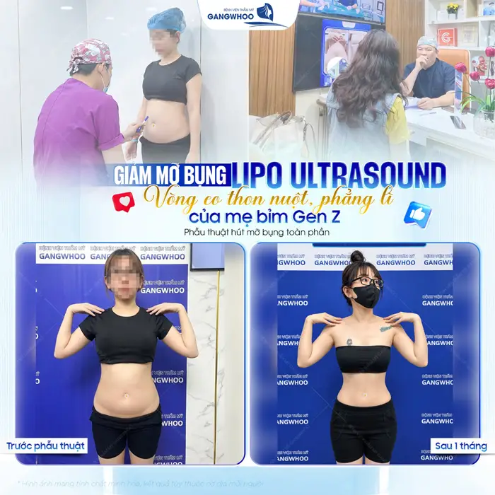Giảm mỡ công nghệ Lipo Ultrasound vòng eo thon nuột, phẳng lì của mẹ GenZ đẹp xuất sắc