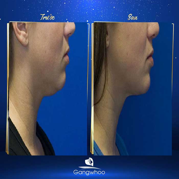 Images of our customers before & after Chin Liposuction