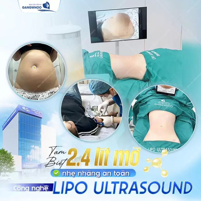 Hút Mỡ Toàn Thân An Toàn, Không Biến Chứng, Hiệu Quả Cao 15 Tạm biệt mỡ bụng nặng nề sau giảm mỡ công nghệ Lipo Ultrasound một cách nhẹ nhàng và nhanh chóng