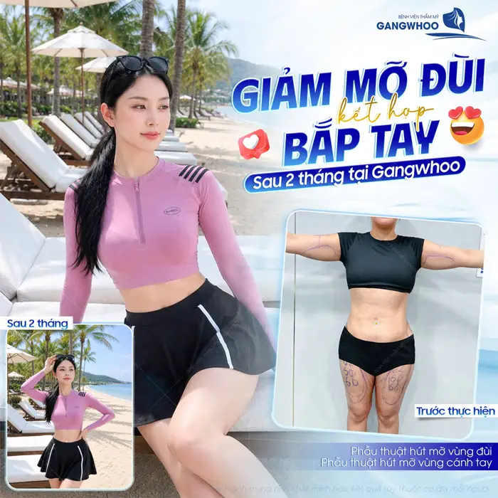 Giảm mỡ đùi kết hợp mỡ bắp tay sau 2 tháng tại Gangwhoo body đẹp chấn động