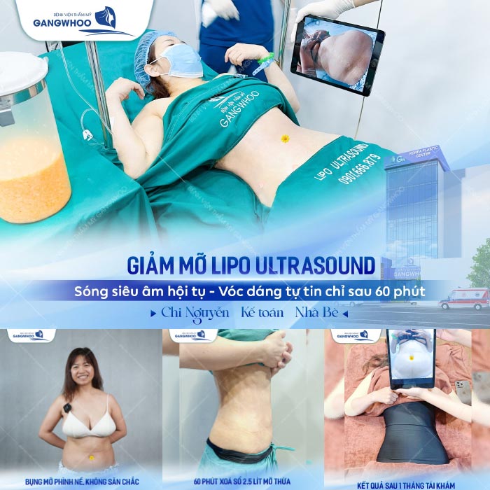 Hút Mỡ Bụng Lipo Ultrasound Hiệu Quả, Không Sưng Bầm 37 Hút Mỡ Bụng Lipo Ultrasound