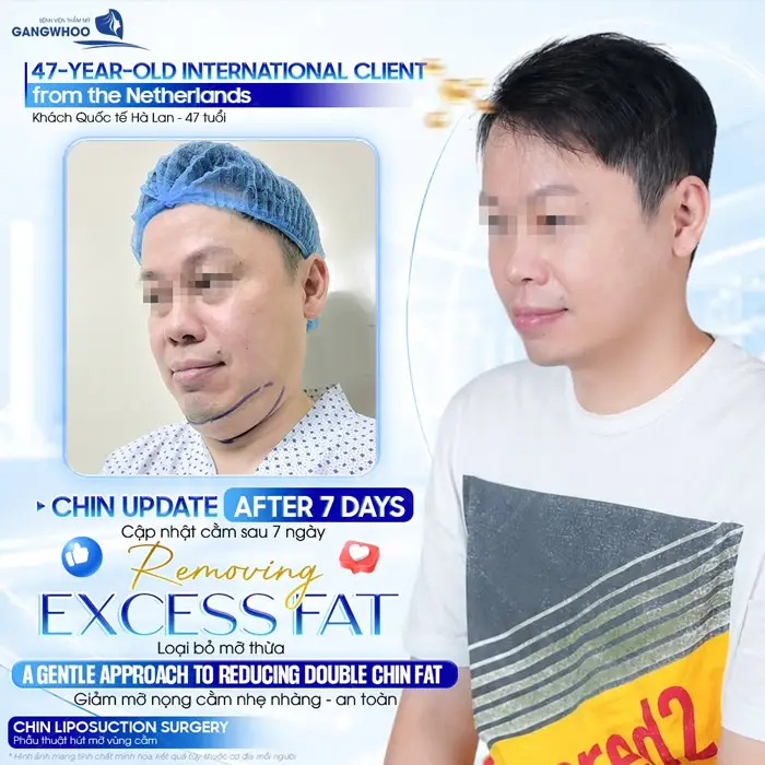Cập nhật kết quả sau 7 ngày hút mỡ nọng cằm tại bệnh viện thẩm mỹ Gangwhoo cho vị khách đến từ Hà Lan 