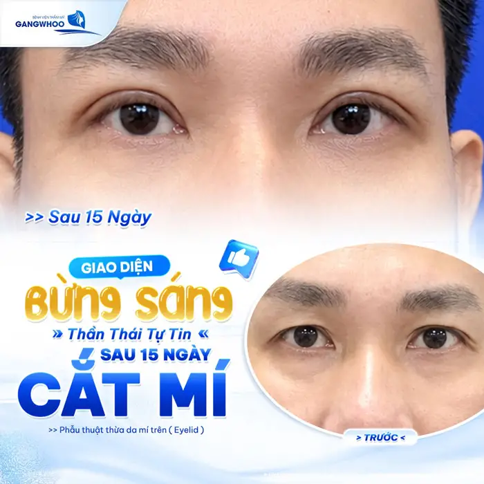 Giao diện bừng sáng sau 15 ngày cắt mí thần thái tự tin đôi mắt thêm chiều sâu cuốn hút