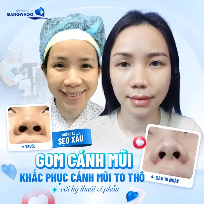 Phẫu Thuật Thu Gọn Cánh Mũi Khắc Phục Mũi To Bè Trở Nên Thon Gọn 8 Thu gọn cánh mũi khắc phục cánh mũi to thô với kỹ thuật vi phẫu hiện đại và an toàn