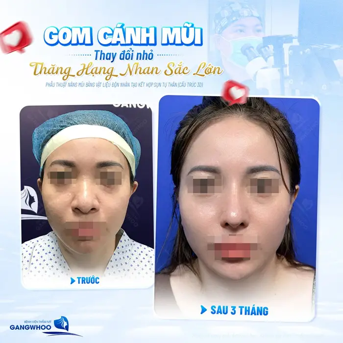 Gom cánh mũi thay đổi nhỏ thăng hạng nhan sắc lớn sự lột xác hoàn toàn sau 1 ca phẫu thuật