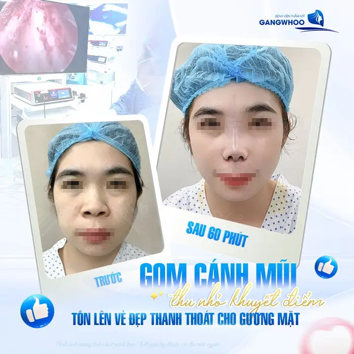 Phẫu Thuật Thu Gọn Cánh Mũi Khắc Phục Mũi To Bè Trở Nên Thon Gọn 3 Thu gọn cánh mũi tạm biệt khuyết điểm hiệu quả tônlên vẻ đẹp thanh thoát cho khuôn mặt