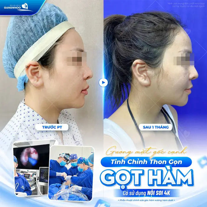 Gương mặt góc cạnh tinh chỉnh đường nét thon gọn sau gọt hàm có sử dụng nội soi 4K