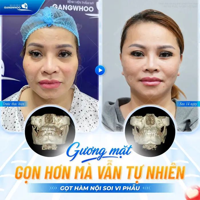 Phẫu Thuật Gọt Hàm V-Line Vi Phẫu Là Gì? Có Nguy Hiểm Không? 9 Gương mặt gọn hơn mà vẫn tự nhiên sau gọt hàm nội soi vi phẫu