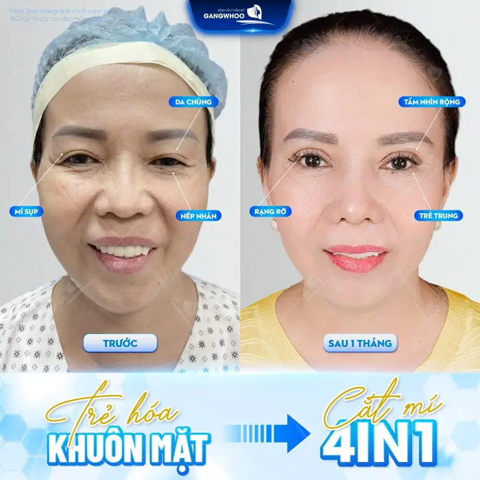 Trẻ hóa khuôn mặt chỉ với 1 can thiệp nhỏ bằng kỹ thuật cắt mí 4 In 1