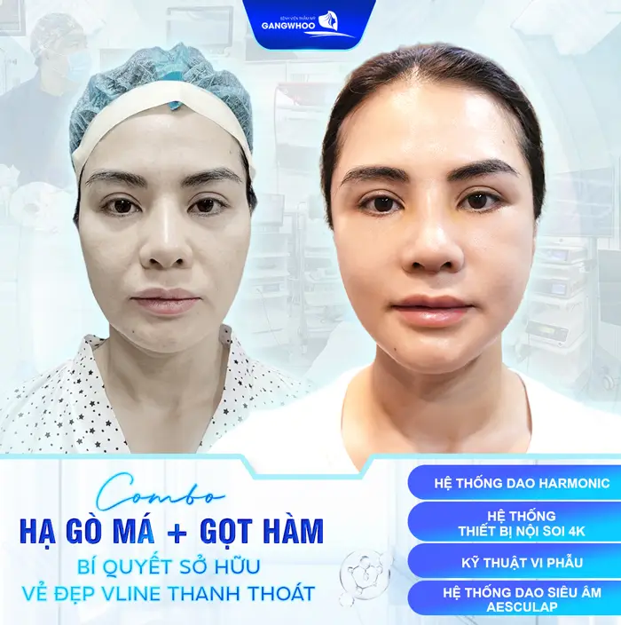 Gọt Hàm Nghỉ Dưỡng Bao Lâu Và Các Yếu Tố Ảnh Hưởng 15 Gọt Hàm Nghỉ Dưỡng Bao Lâu Và Các Yếu Tố Ảnh Hưởng