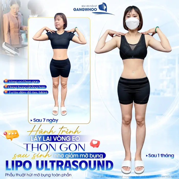 Hành trình lấy lại vòng eo sau sinh nhờ giảm mỡ bụng công nghệ Lipo Ultrasound