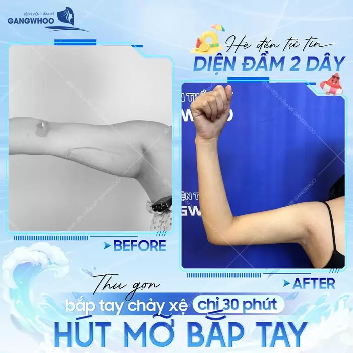 Hút Mỡ Cánh Tay Giúp Lấy Lại Đôi Tay Thon Gọn Nhanh Chóng 26 Hút mỡ bắp tay