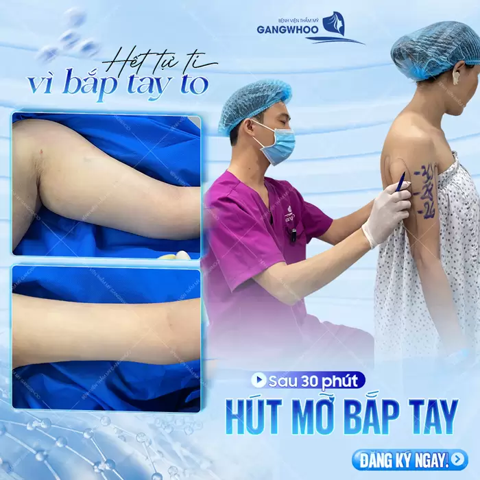 Hút Mỡ Cánh Tay Giúp Lấy Lại Đôi Tay Thon Gọn Nhanh Chóng 5 Hết tự ti vì bắp tay to giải quyết mỡ thừa chỉ sau 30 phút thực hiện