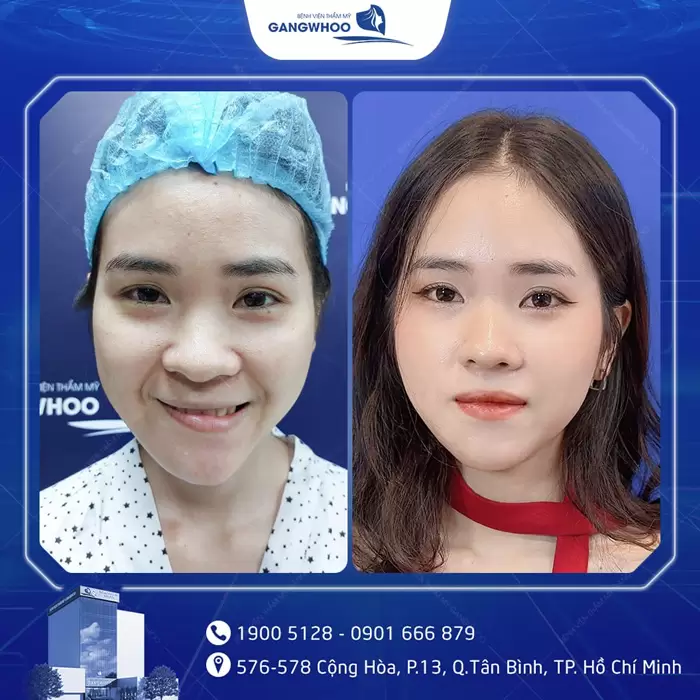 Điều Trị Liệt Mặt Nội Soi 4K - Lấy Lại Nụ Cười Trên Gương Mặt 11 hinh anh dieu tri liet mat 1