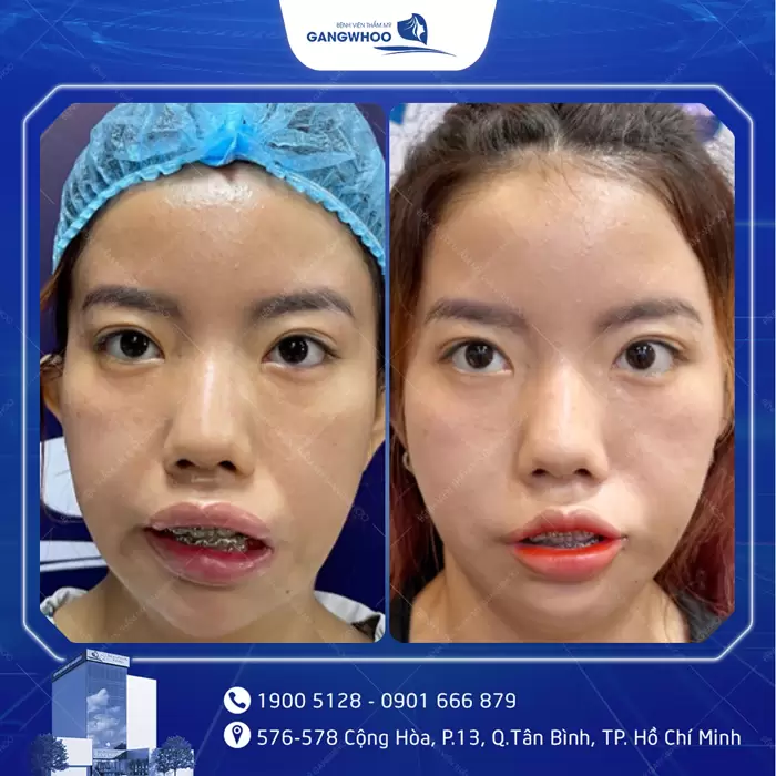 Điều Trị Liệt Mặt Nội Soi 4K - Lấy Lại Nụ Cười Trên Gương Mặt 16 hinh anh dieu tri liet mat 15